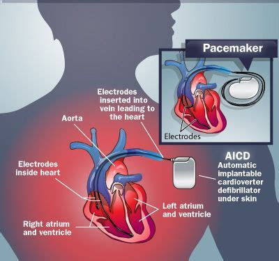 electrical transformer box and pacemaker interference|interference with icds and pacemakers.